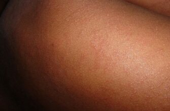 корь, вирус