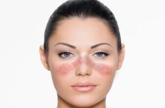 Красная волчанка